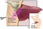 Role of interventional radiology in endocrine diseases - Review article(Review)